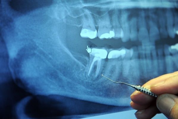 Chụp X quang răng có tác dụng gì? Chụp X quang răng giá bao nhiêu?